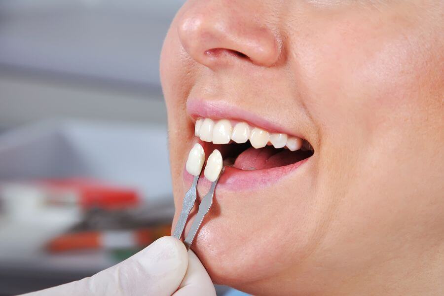 Tratamiento de carillas dentales