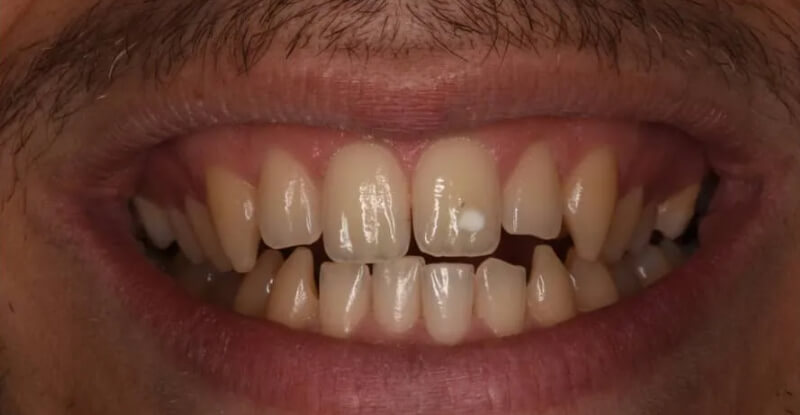 Cómo se ve hipoplasia dental