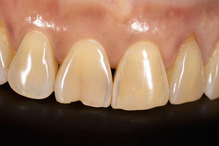 Cómo se ve un diente astillado