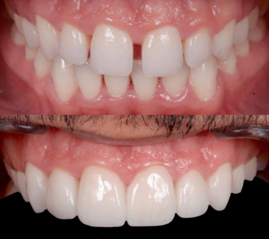 Corregir un diastema en dientes separados
