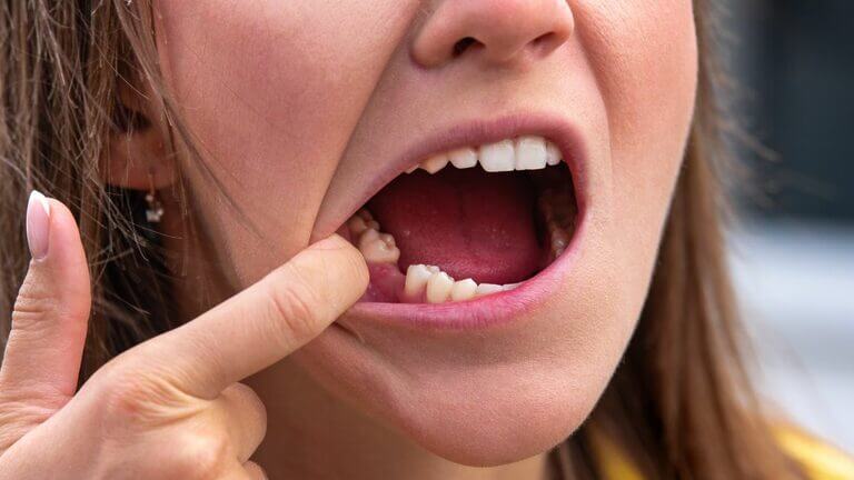 Se pueden poner implantes dentales sin hueso