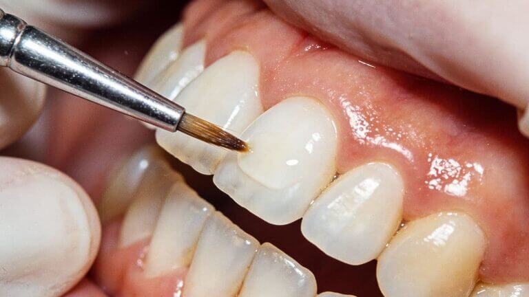 Qué hacer si tienes un diente astillado