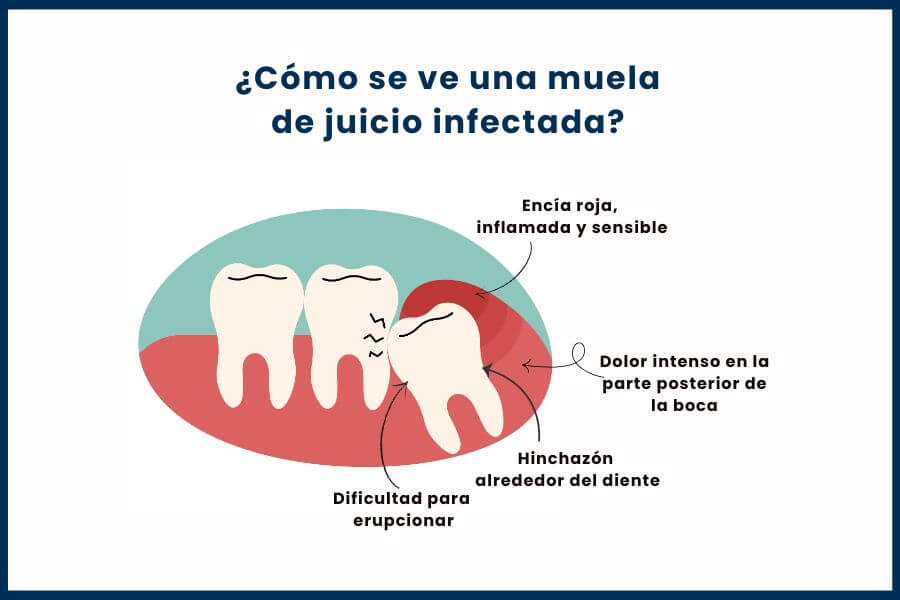 Cómo se ve muela juicio infectada