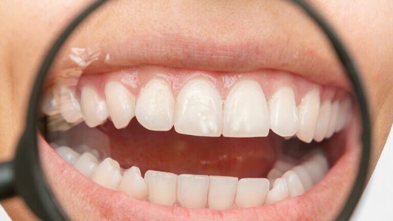 Manchas blancas en los dientes ¿Cuáles son sus causas y tratamientos?