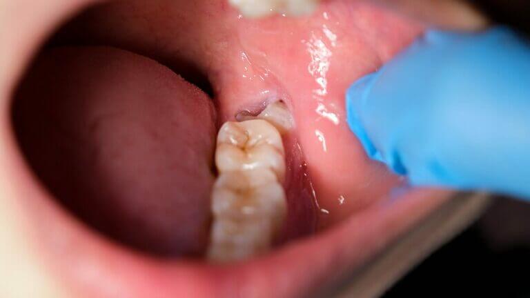 Síntomas de una muela del juicio infectada