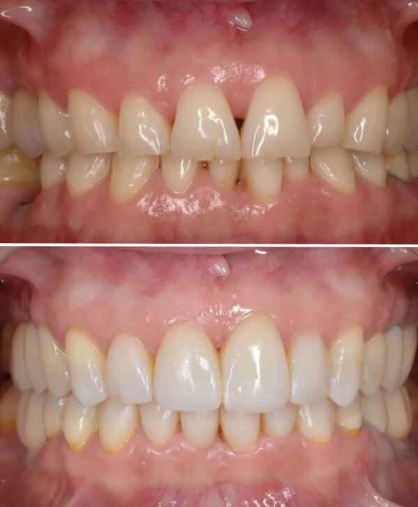 Antes y después de tratar el bruxismo y las troneras dientes