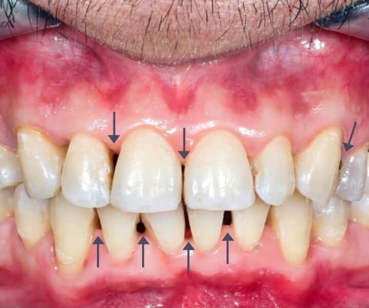 ¿Qué son las troneras dentales?