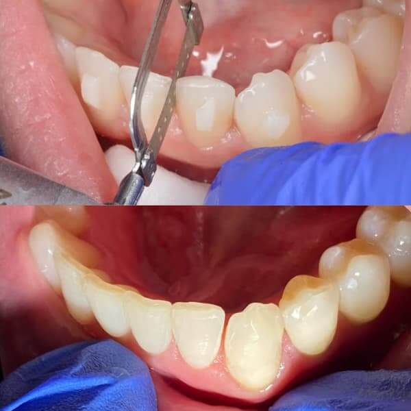 Antes y después de stripping dental