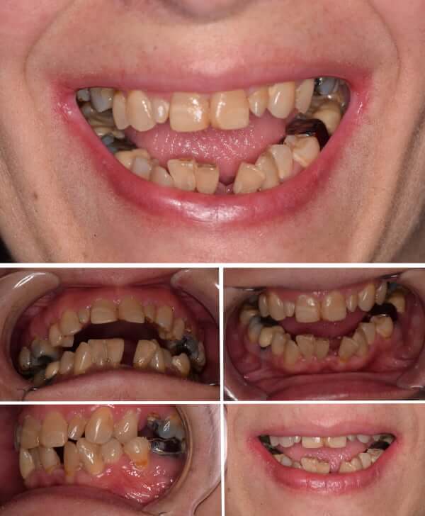 Boca con enfermedad periodontal y piezas dentales ausentes