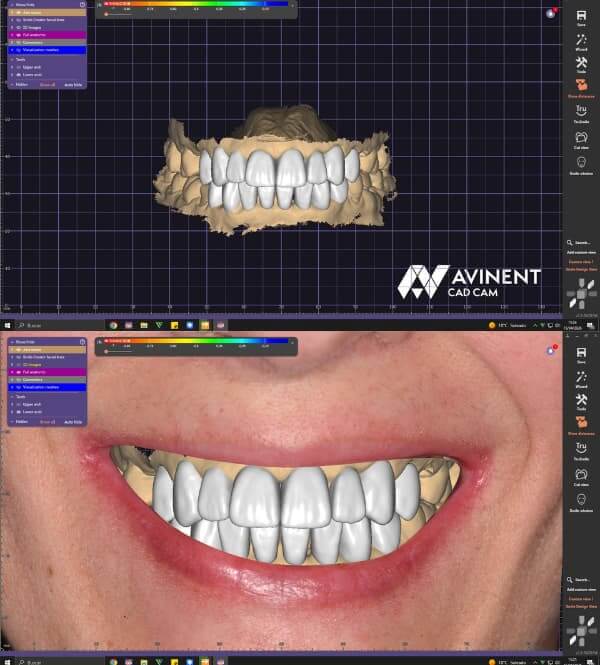Diseño digital de la sonrisa