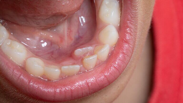 Por qué salen los dientes de tiburón en niños