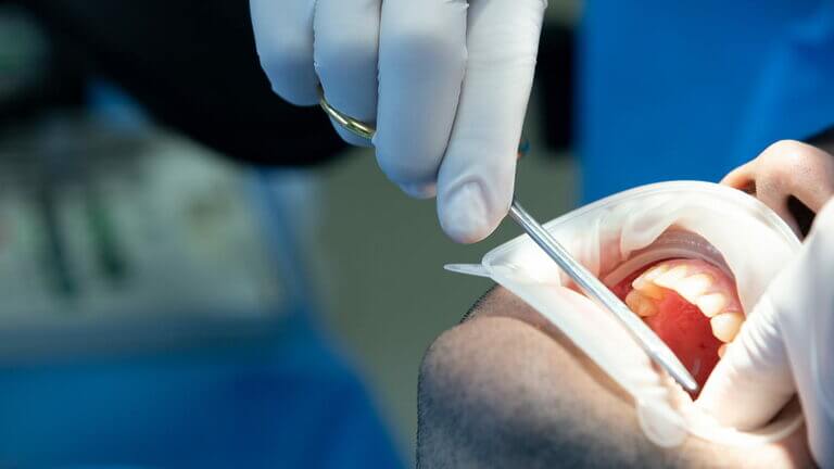 se puede salvar un diente con periodontitis