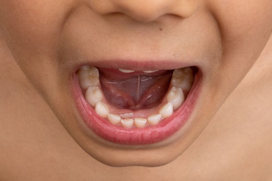 Qué son los dientes de tiburón o en doble fila