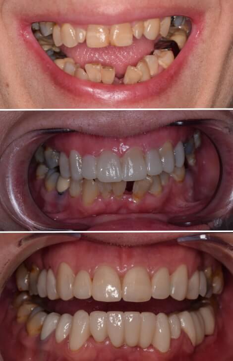 Rehabilitación oral completa