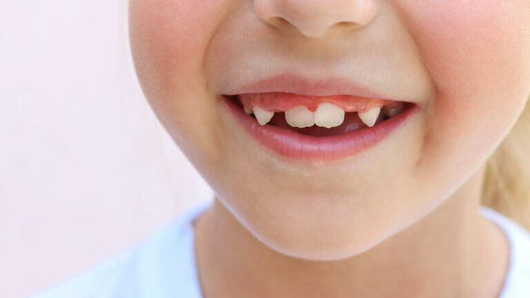 Gingivitis en niños, enfermedad infantil