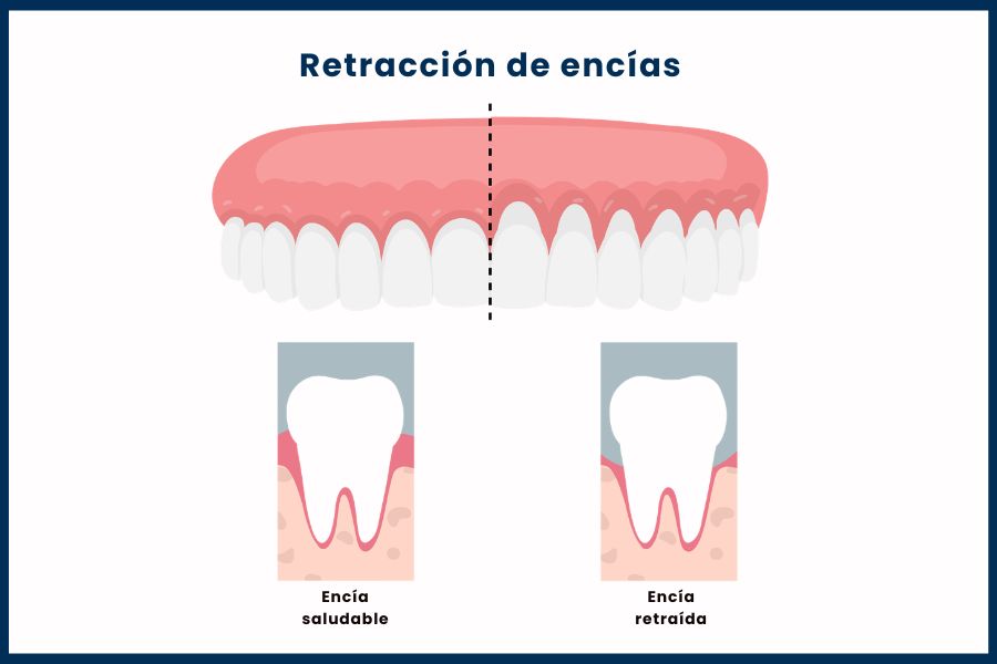 Retracción de encías Vs encía saludable