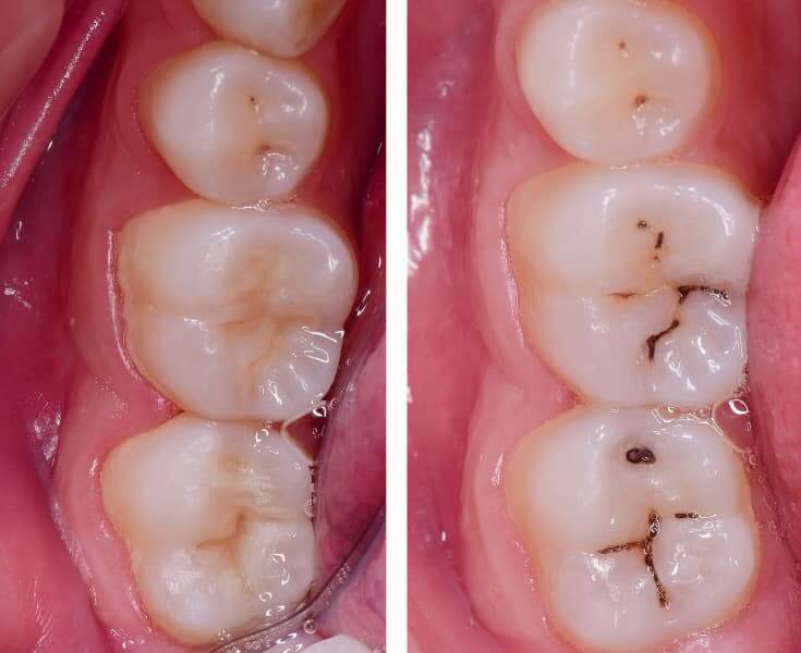 ¿Cómo saber si necesito empaste dental o endodoncia?
