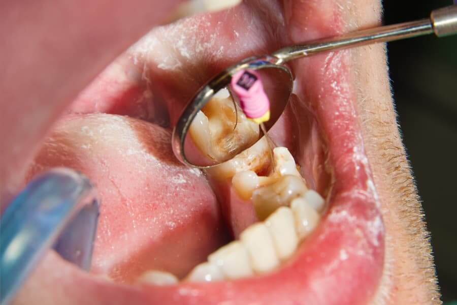 ¿Cómo saber si necesito endodoncia o empaste?