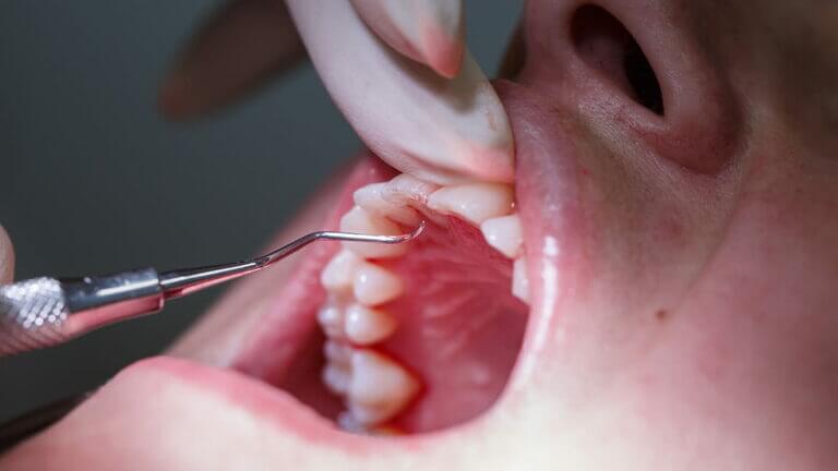 ¿Qué es un mantenimiento periodontal?