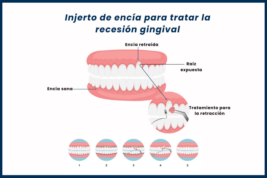 Tratamiento para recesión gingival