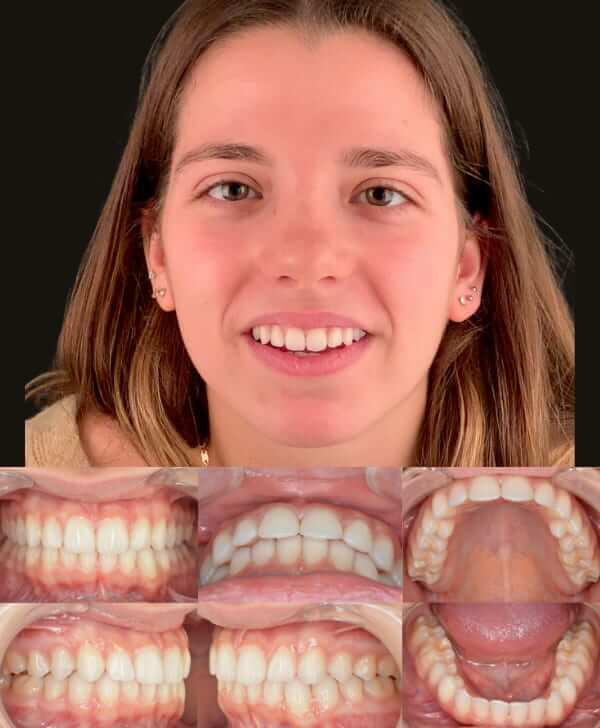 Despues recidiva dental