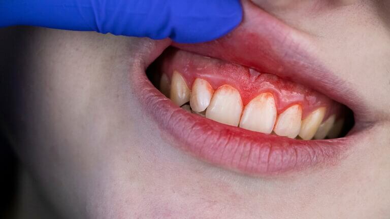 Gingivitis en el embarazo