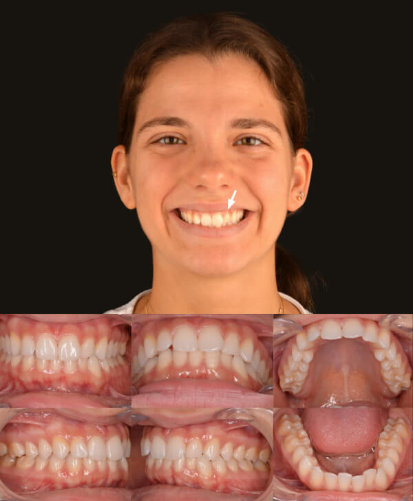 Recidiva dental