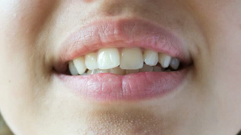 ¿Se mueven dientes después de la ortodoncia?