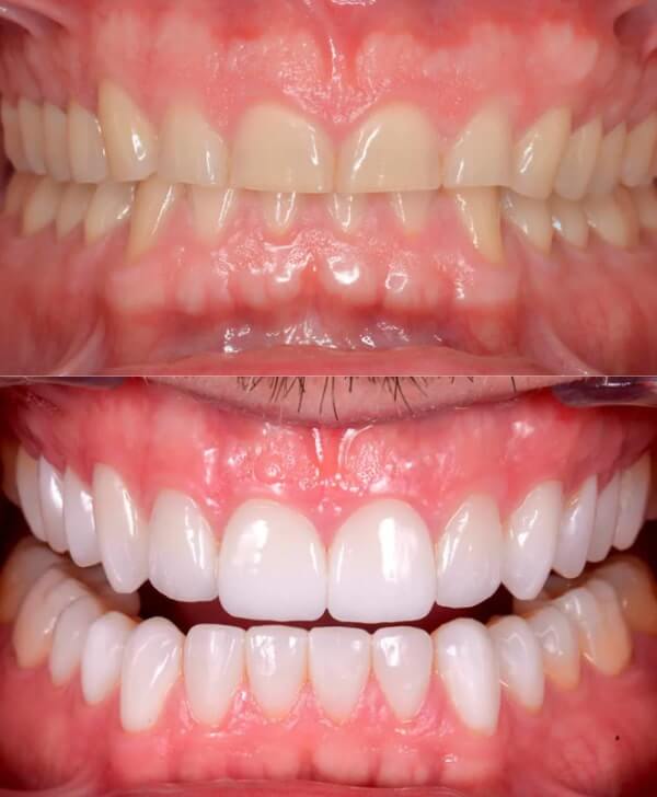 Antes y después de tener los dientes desgastados por bruxismo