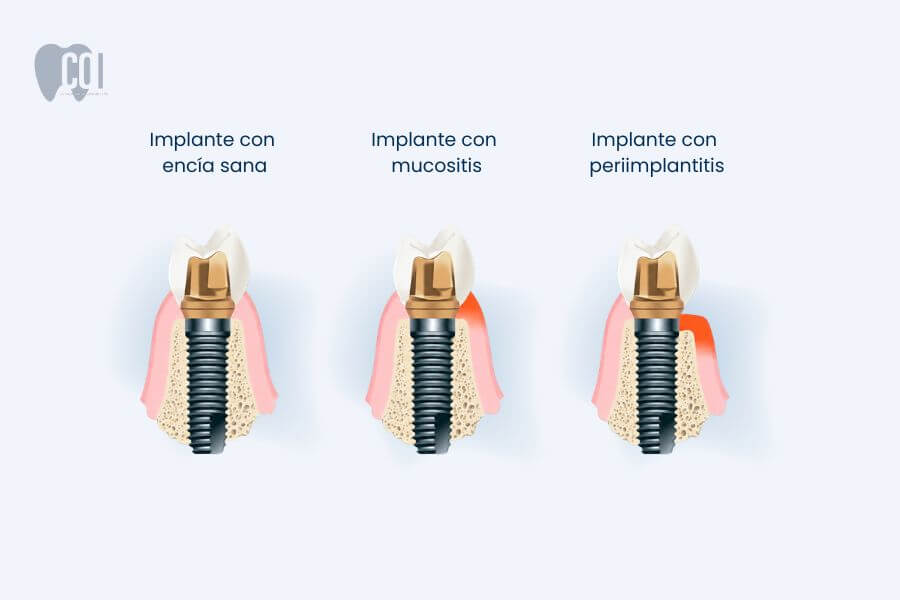 Enfermedades de infección en un implante dental