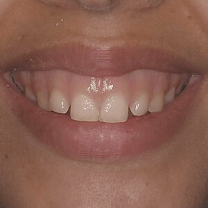 Alargamiento coronario - Periodoncia - COI Clinica Dental Granollers
