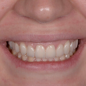 COI Clinica Dental Granollers - Estetica Dental - Coronas dentales de ceramica