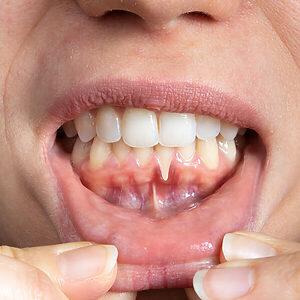 Cirugía mucogingival - Periodoncia - COI Clinica Dental Granollers