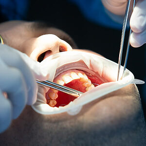 Cirugía regenerativa - Periodoncia - COI Clinica Dental Granollers