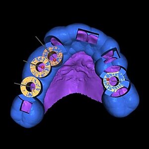 Implantes de carga inmediata
