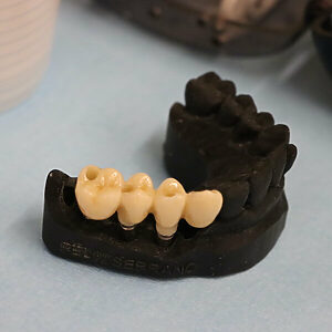 Puentes dentales Granollers