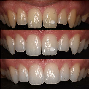 Blanqueamiento dental con reconstrucción estética