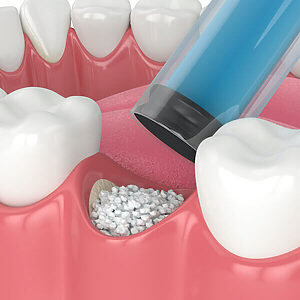 Regeneración ósea dental