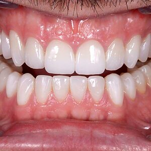 Rehabilitación oral completa